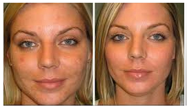 Microdermabrasion/Facials | Newport Beach MedSpa