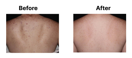 Acne On Back Before And After