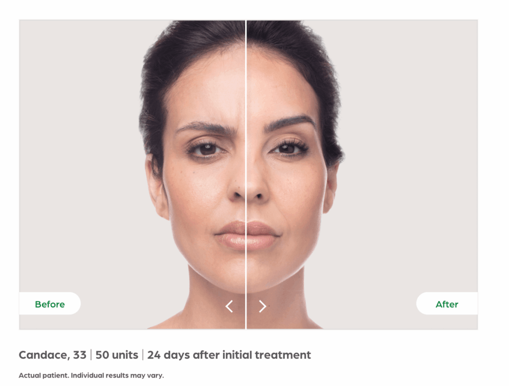 Botox vs. Dysport: Which Wrinkle Relaxer is Right for You?