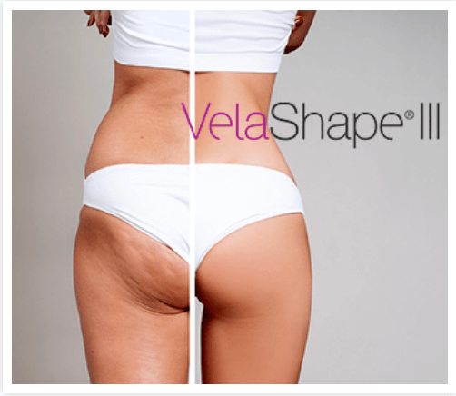 VelaShape 3 Before and After Results