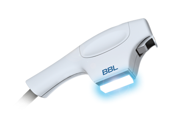 BBL laser treatment