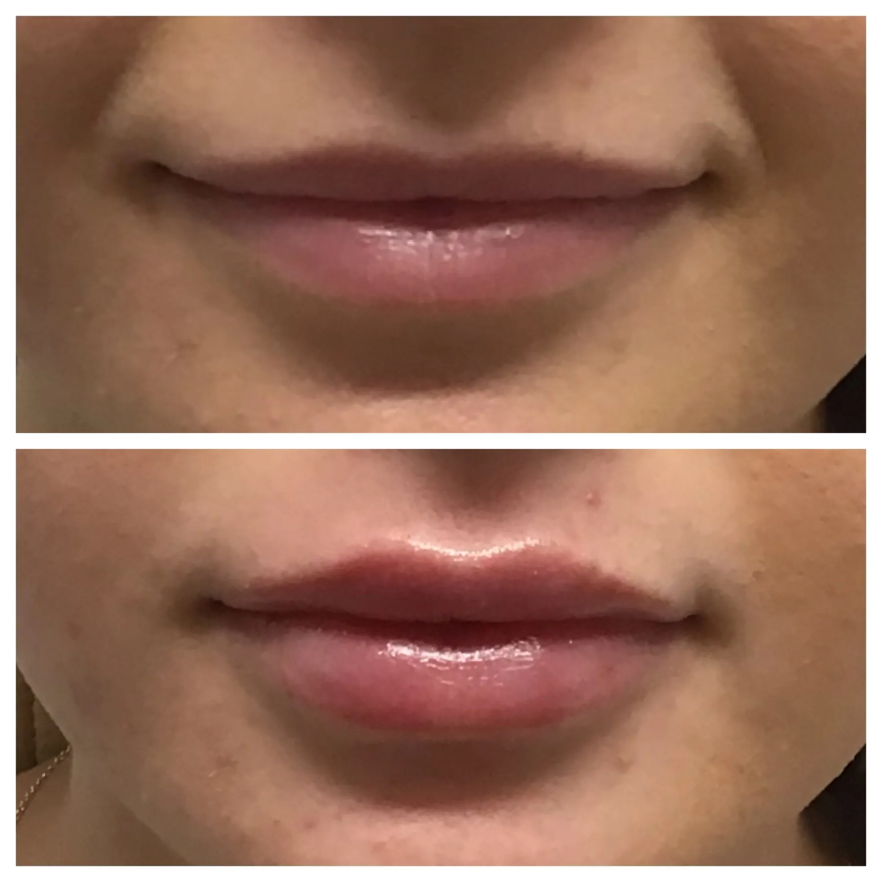 Lip filler before and after result 1 — Newport Beach MedSpa