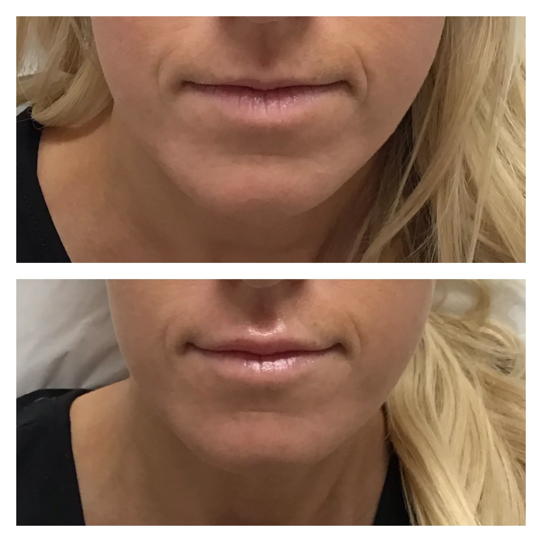 Lip filler before and after result 3 — Newport Beach MedSpa