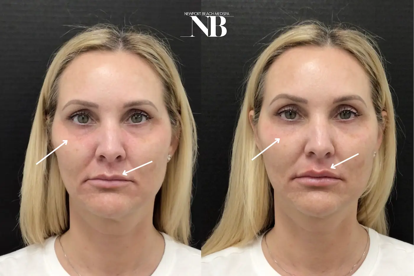 Lip filler before and after result 1 — Newport Beach MedSpa