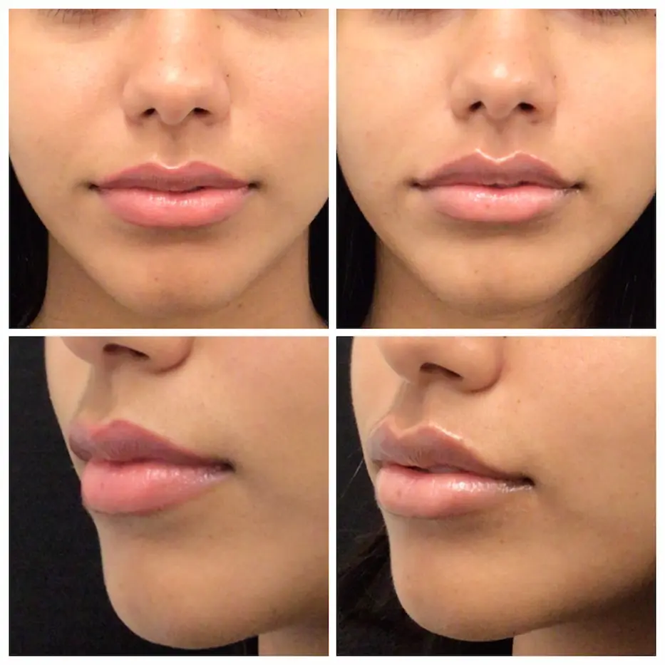 Lip filler before and after result 2 — Newport Beach MedSpa
