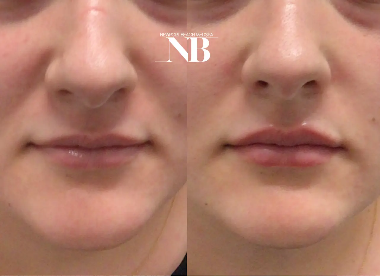 Lip filler before and after result 3 — Newport Beach MedSpa